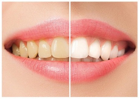 Diş Beyazlatma İşlemi Nasıl Yapılır?