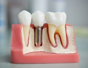 Dental İmplant